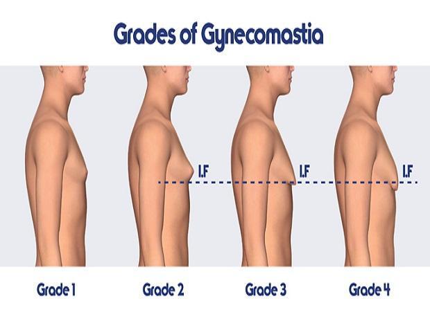 3 Key Factors Men Need to Keep in Mind When Opting for Gynecomastia Surgery