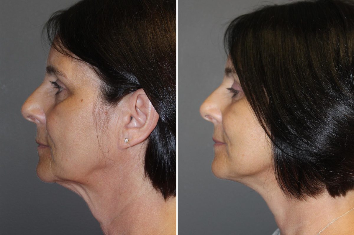 best facelift specialists in Chicagoland